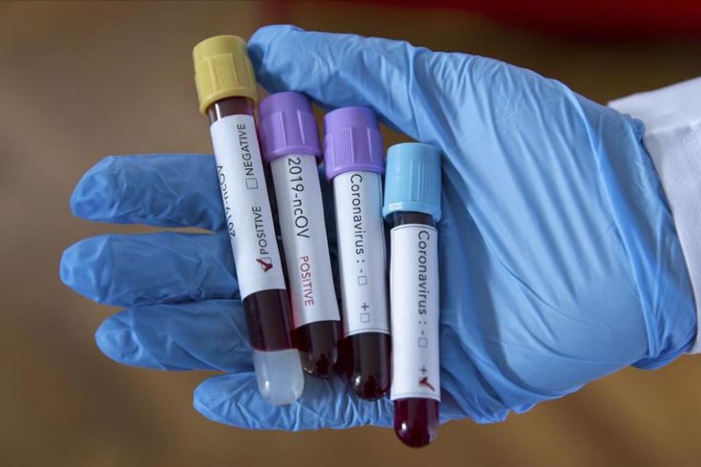 KKTC'de 3 yeni vaka! Temaslıları araştırılıyor