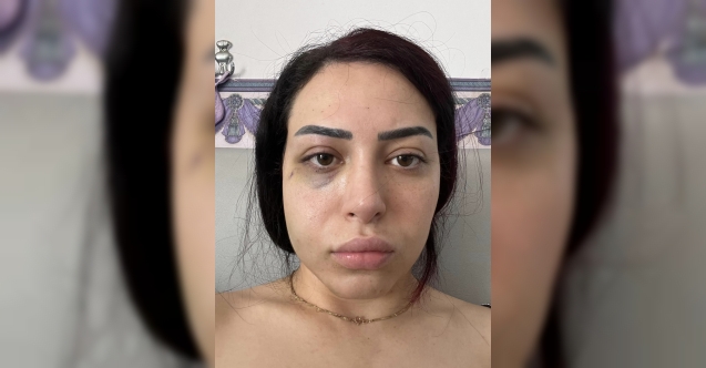 Ayia Napa’da tacize uğrayıp, darp edildi! Hakkını arıyor