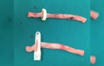 YDÜ’den yeni tasarım göbek kordonu